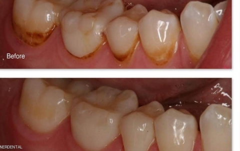 البقع البنية على الأسنان.. هل من طريقة للتخلص منها؟