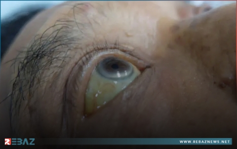 اسباب اصفرار العين و8 طرق طبيعية لعلاجها