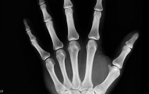 كيف تحمي عظامك مع تقدمك في العمر