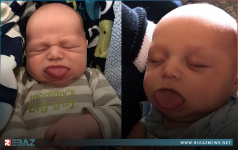 طفل يخضع لعملية تقصير لسان لإنقاذ حياته 