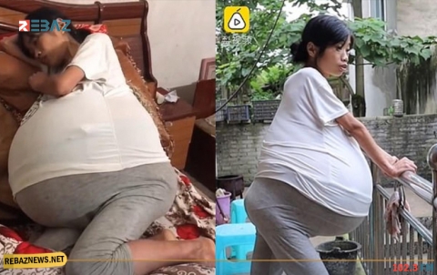 صينية تعانى من نمو في البطن لا يمكن السيطرة عليه.. بسبب حالة غامضة!