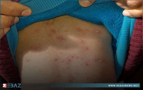 جدري الماء مرض جلدي ينهش أجسام الأطفال في سري كانيه