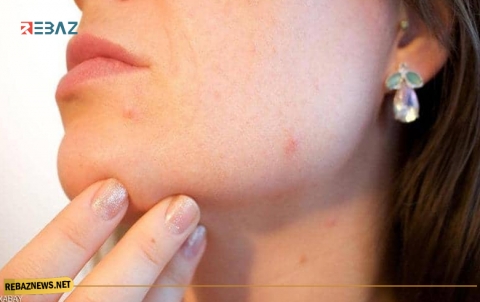  هل تعاني من حب الشباب؟.. هذه الأطعمة تكافحه