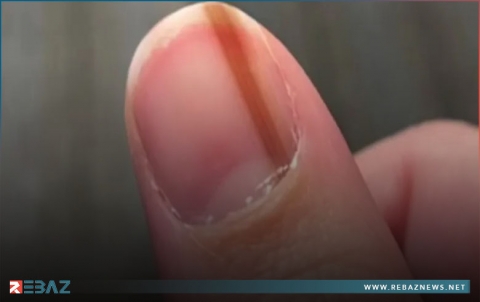 عانت من خط تحت ظفرها لـ10 سنوات.. ثم اكتشفت 