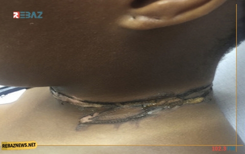 شاحن هاتف يحدث حروقا من الدرجة الثانية برقبة صاحبته 