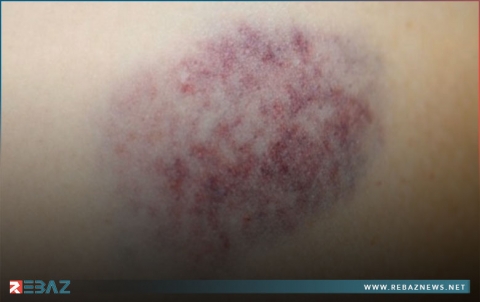 5 أسباب تؤدي لظهور الكدمات بجسمك.. واحد منها خطير جداً