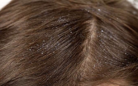 قشرة الرأس قد ترتبط بمرض خطير
